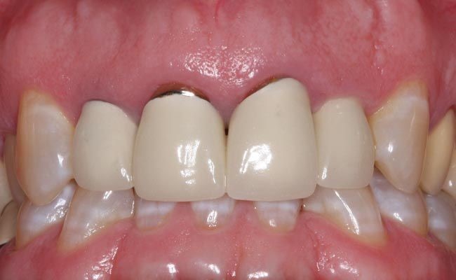 bọc răng sứ có tẩy trắng được không