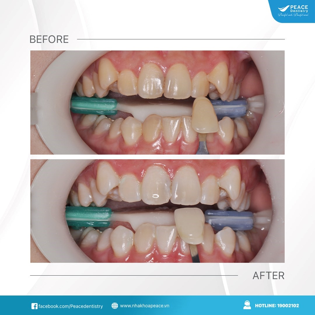 hình ảnh tẩy trắng răng tại peace dentistry