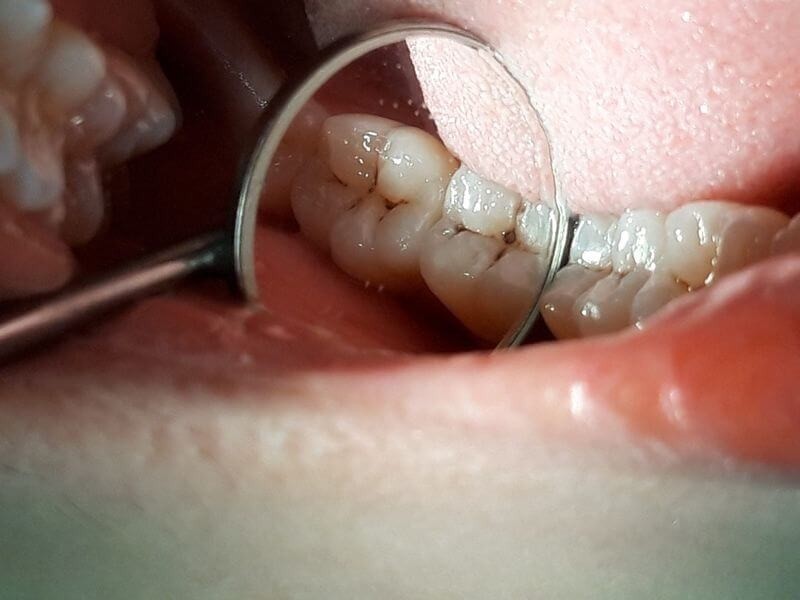 nguyên nhân áp xe răng