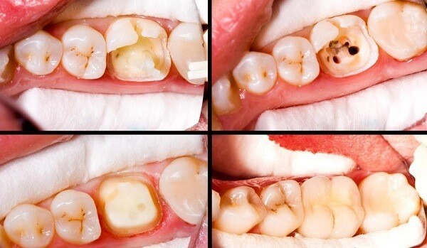 chữa tủy răng số 7