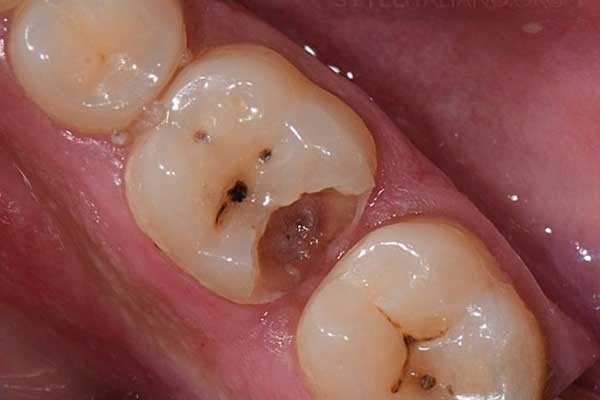 răng số 6 bị sâu có nên nhổ không