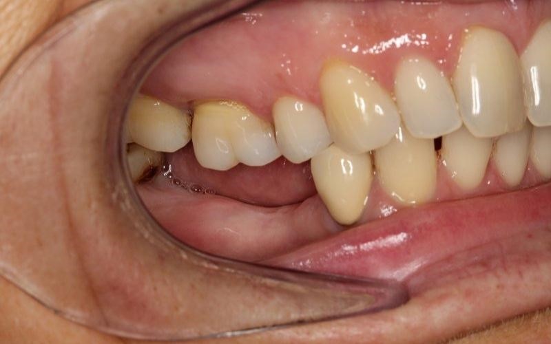 tiêu xương hàm khi mất răng số 6