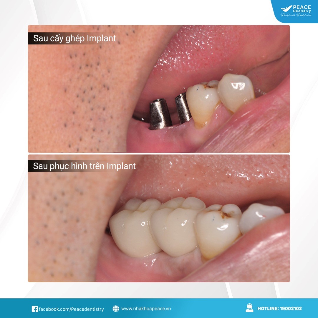trồng răng số 6 bằng phương pháp implant