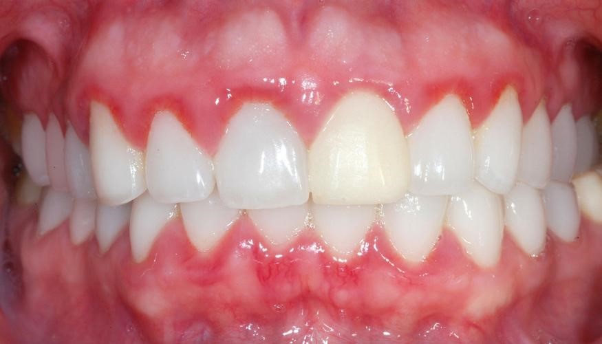 nguyên nhân bị nhiễm trùng khi bọc răng sứ