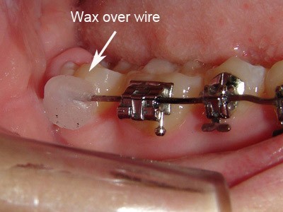 cách khắc phục niềng răng bị chảy máu chân răng