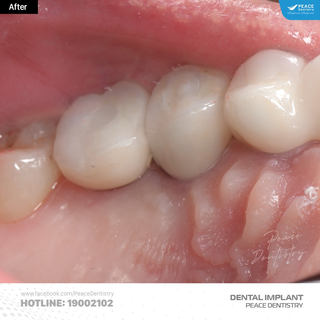 trồng răng implant kết hợp nâng xoang kín ghép xương gbr 10