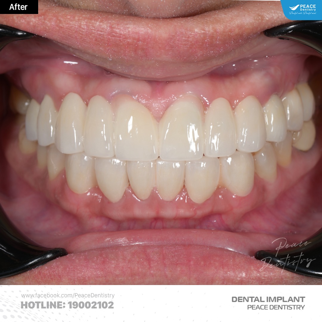 trồng răng implant kết hợp nâng xoang kín ghép xương gbr 11