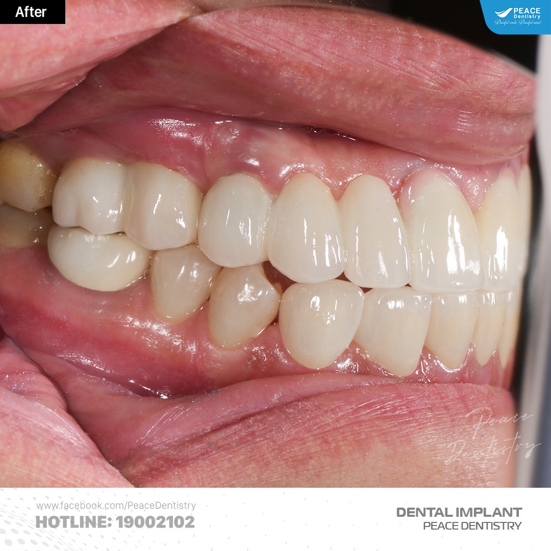 trồng răng implant kết hợp nâng xoang kín ghép xương gbr 12