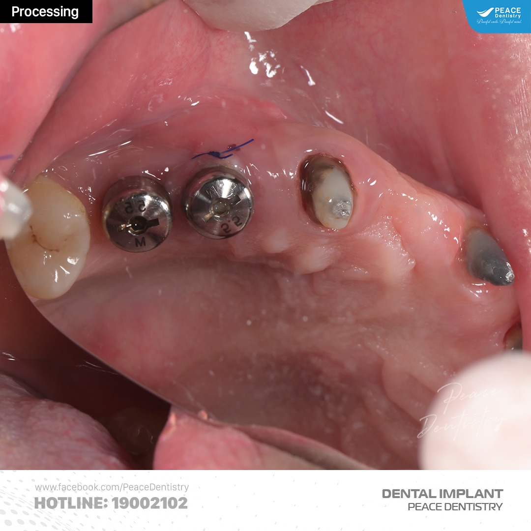 trồng răng implant kết hợp nâng xoang kín ghép xương gbr 5