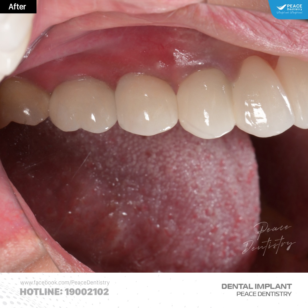 trồng răng implant kết hợp nâng xoang kín ghép xương gbr 9