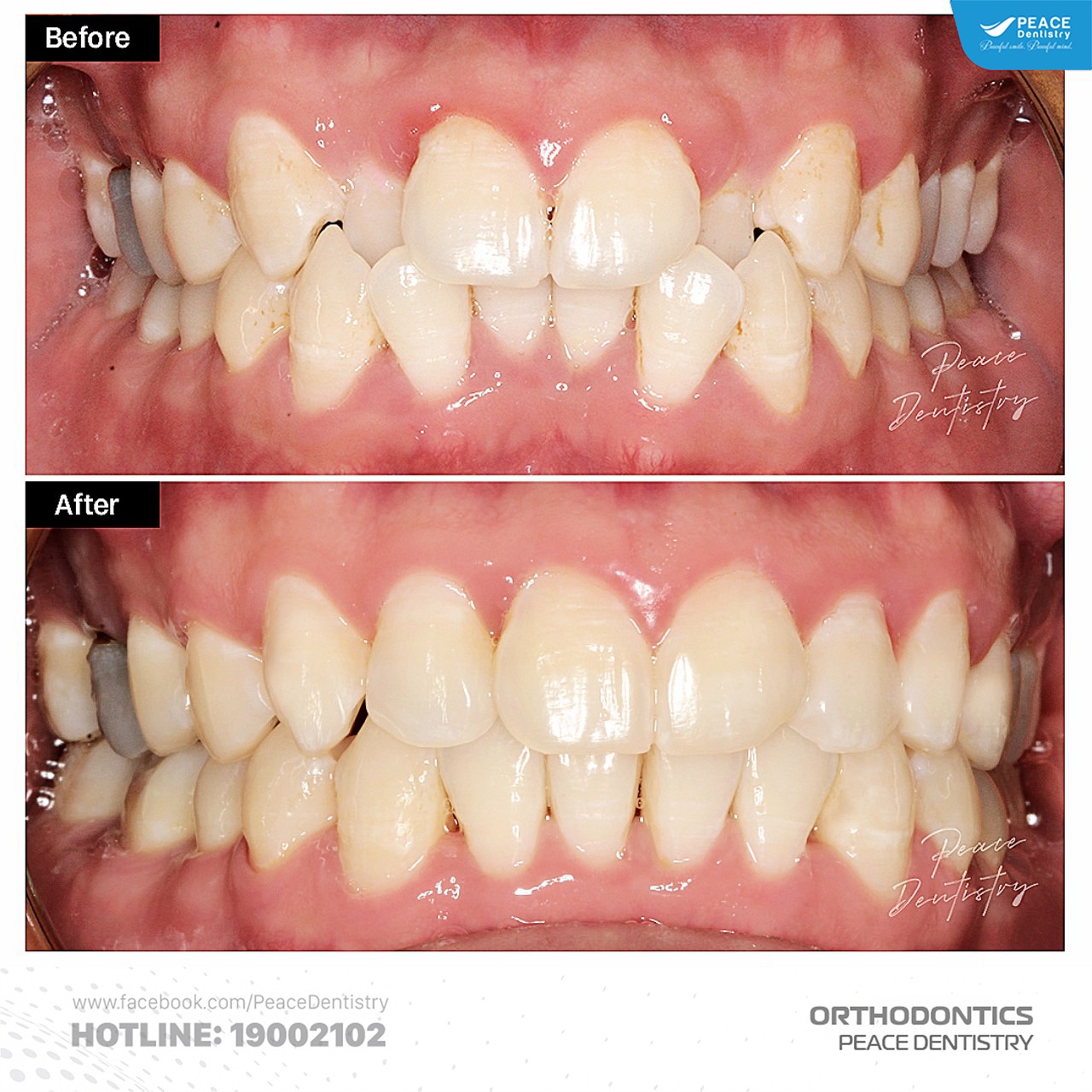 niềng răng invisalign tạo khoảng chỉnh nha không nhổ răng