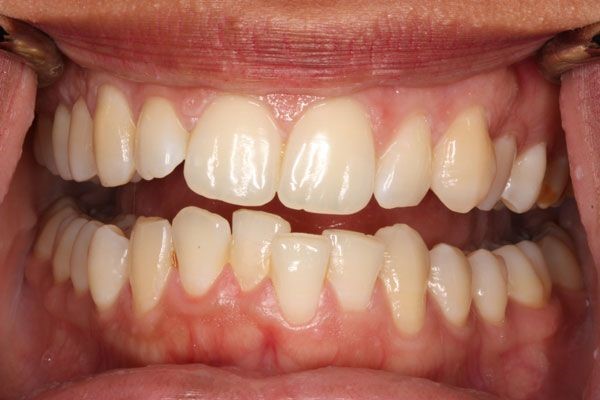 niềng răng xong không đeo hàm duy trì 1