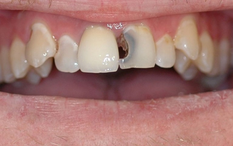 tác hại của răng cửa bị mọc lệch