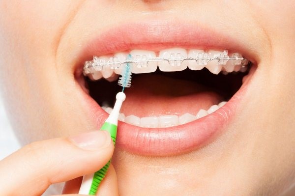 vệ sinh răng miệng khi niềng răng