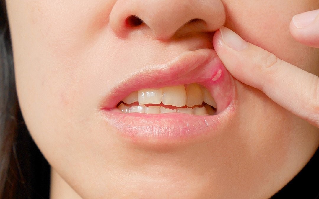 dấu hiệu nhiệt miệng khi niềng răng