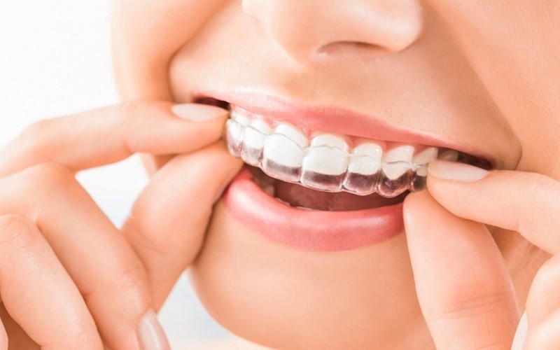 đeo hàm duy trì khắc phục răng bị thưa sau khi niềng
