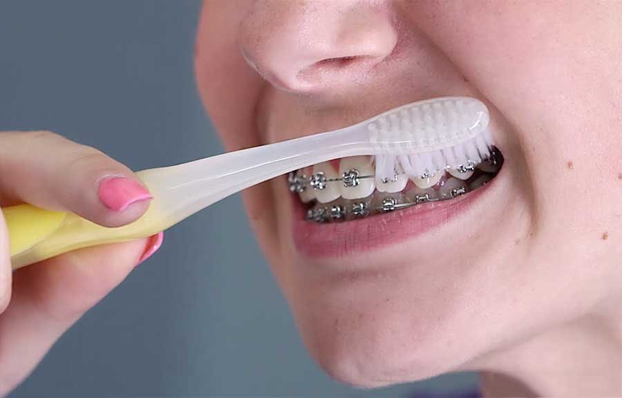 giải pháp khắc phục nhiệt miệng khi niềng răng