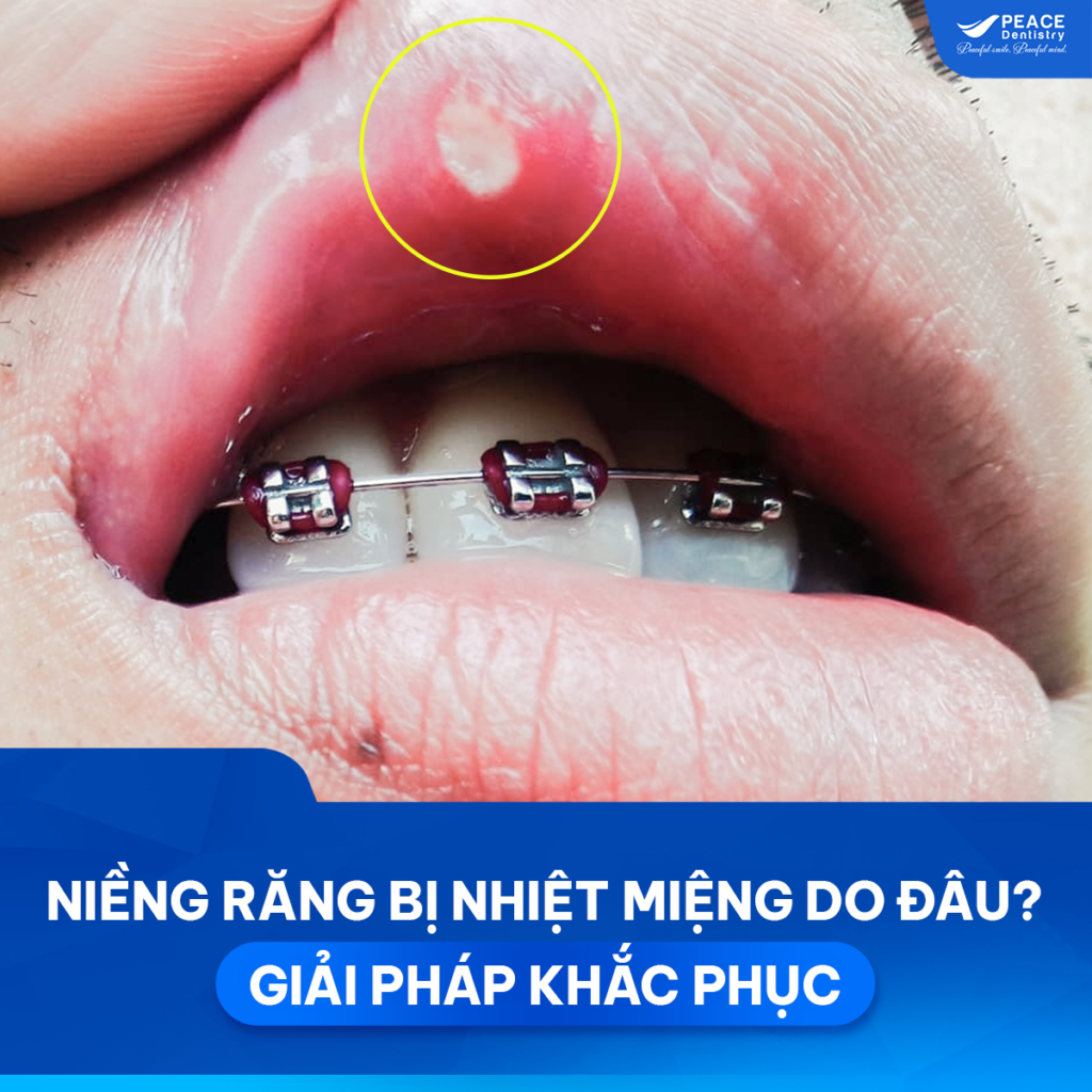 niềng răng bị lở miệng