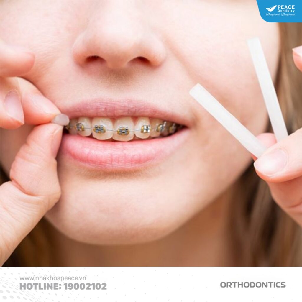 Bôi sáp nha khoa lên mắc cài giúp hạn chế nhiệt miệng khi niềng răng