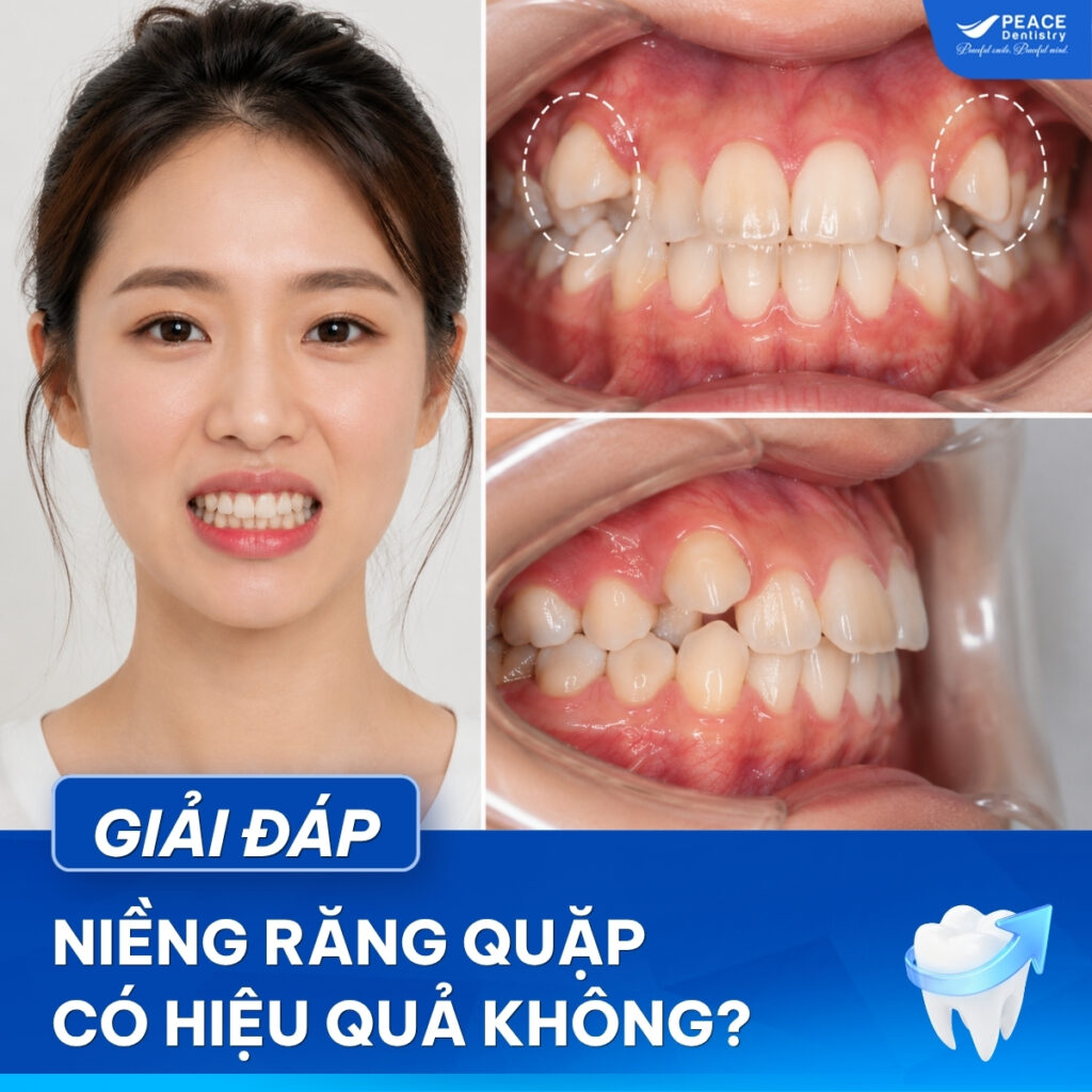 răng quặp có niềng được không