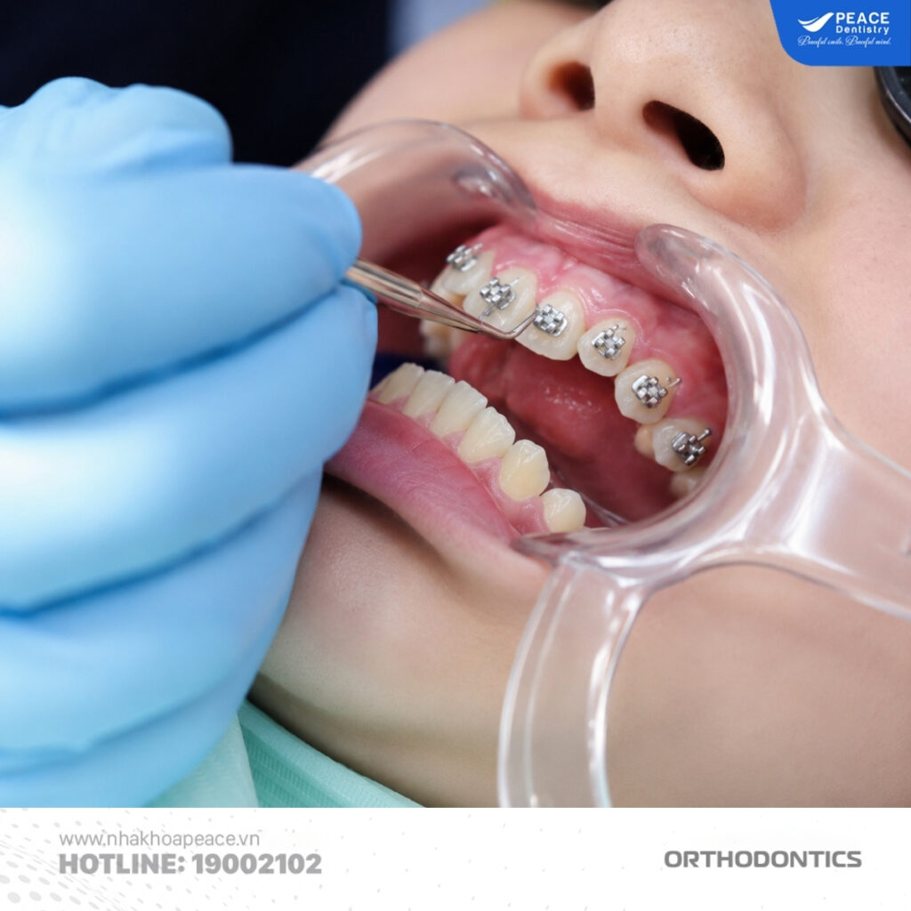 răng quặp có niềng được không