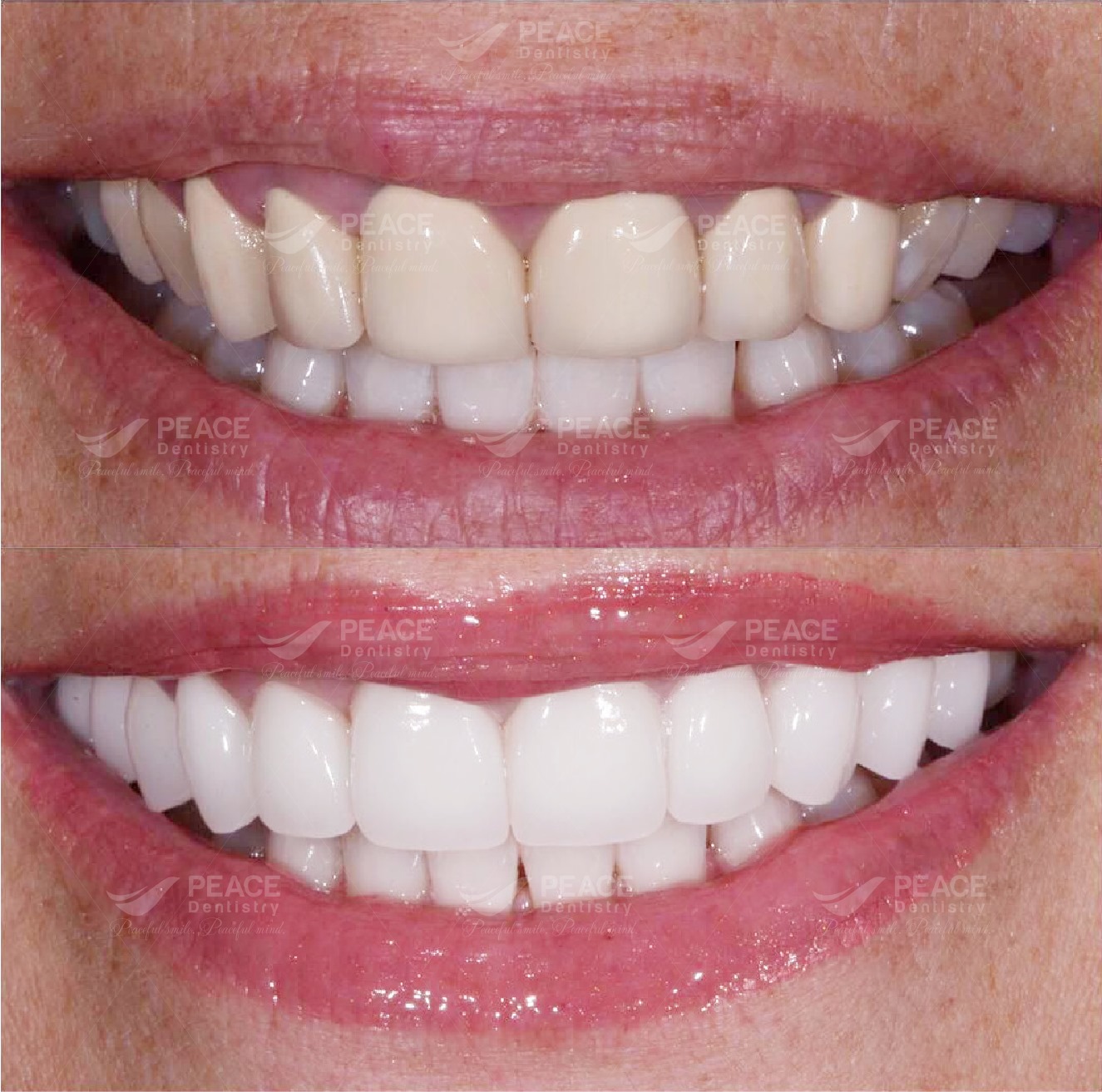 thay răng sứ cũ bằng răng sứ zirconia