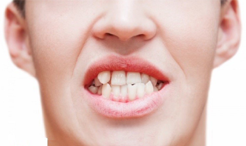 tác hại của răng mọc chồi