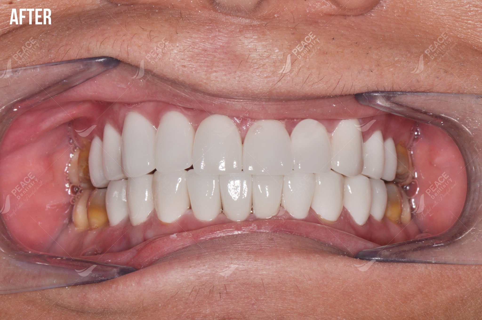 bọc sứ cho răng nhiễm tetracycline