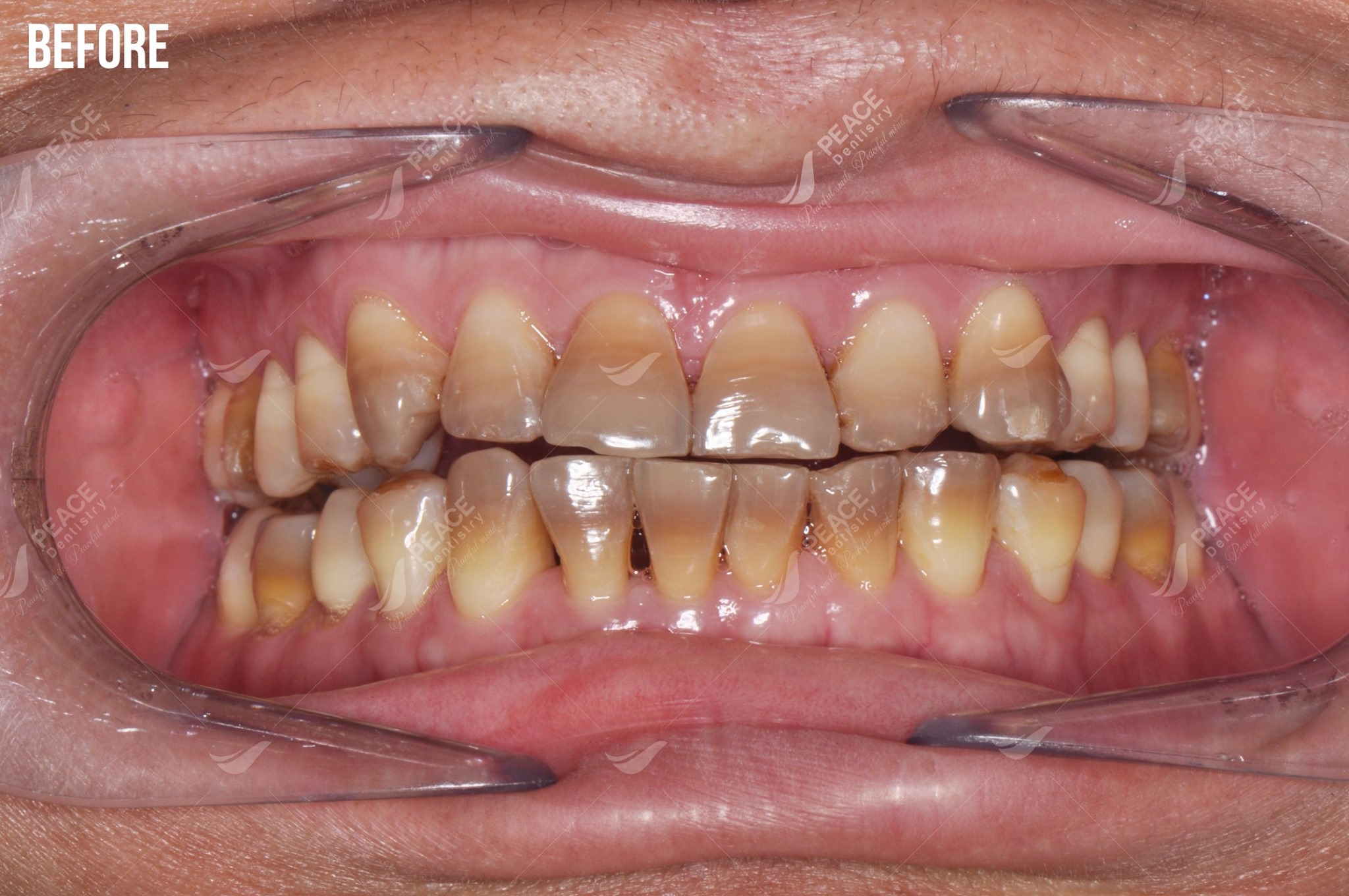 răng nhiễm tetracycline trước khi bọc sứ