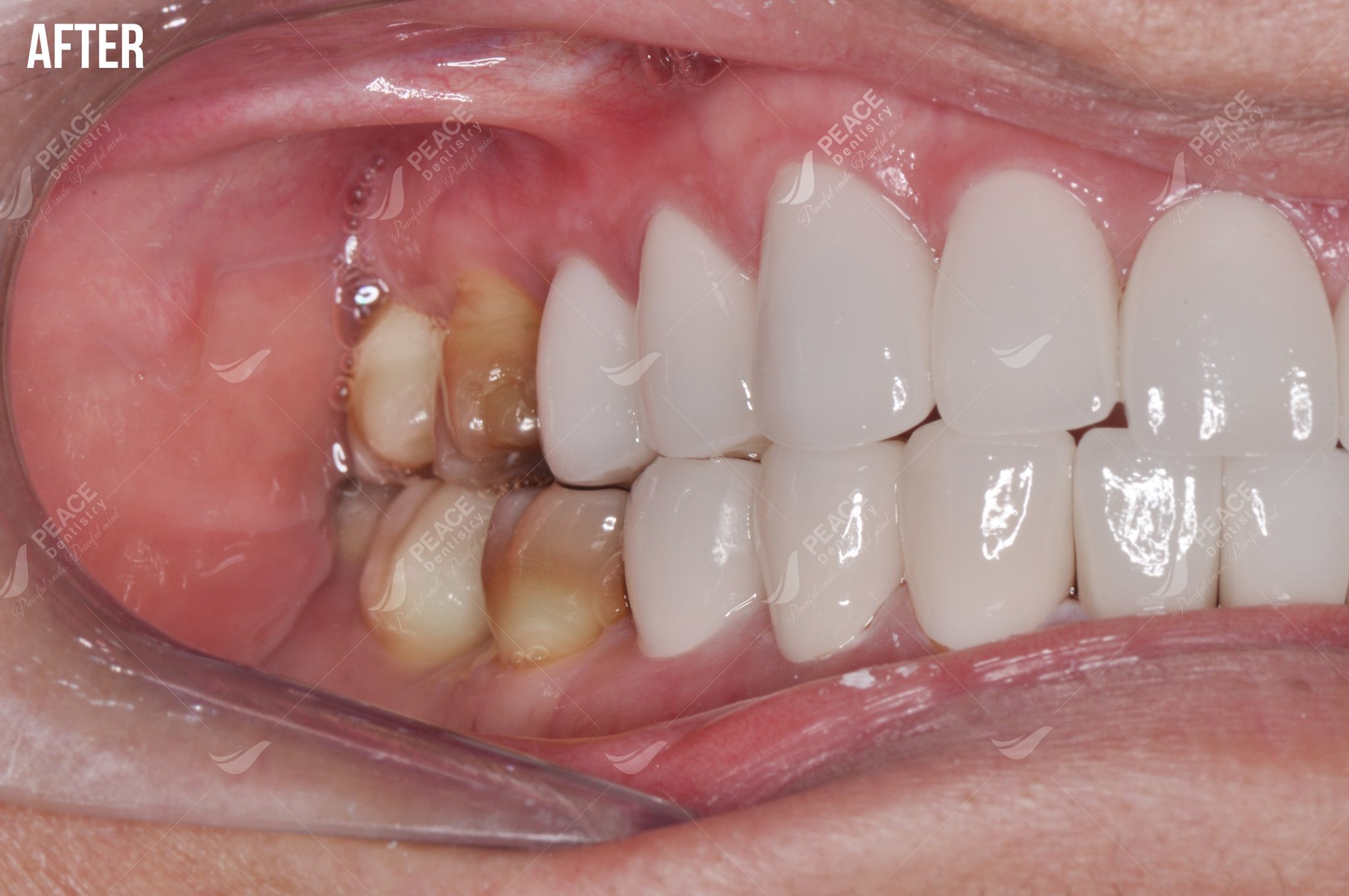 thẩm mỹ răng sứ cho răng nhiễm tetracycline