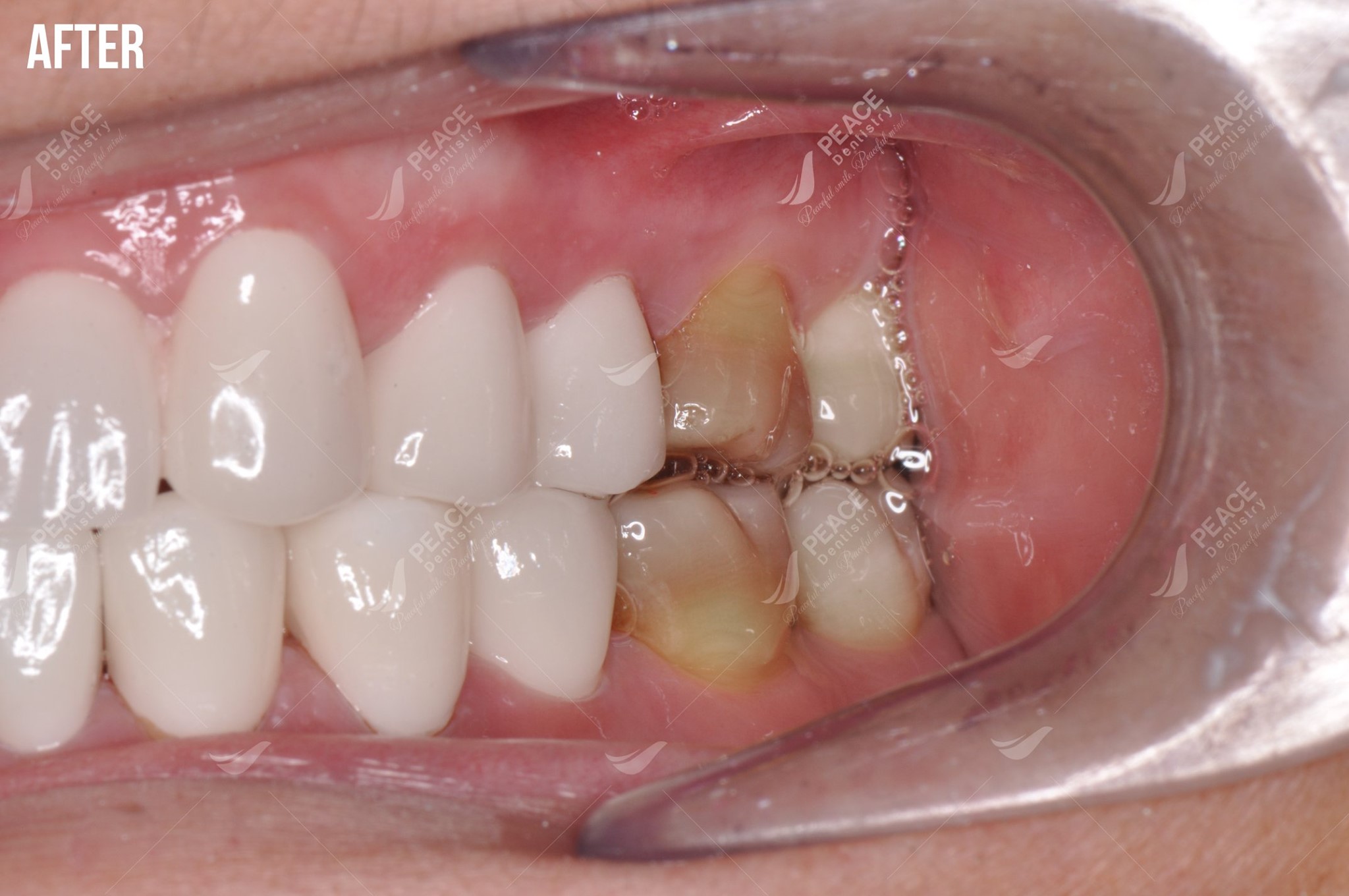 bọc răng sứ thẩm mỹ cho răng nhiễm tetracycline