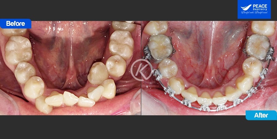 case niềng răng chen chúc, sai khớp cắn lệch đường giữa, hoàn thành sau 2 năm