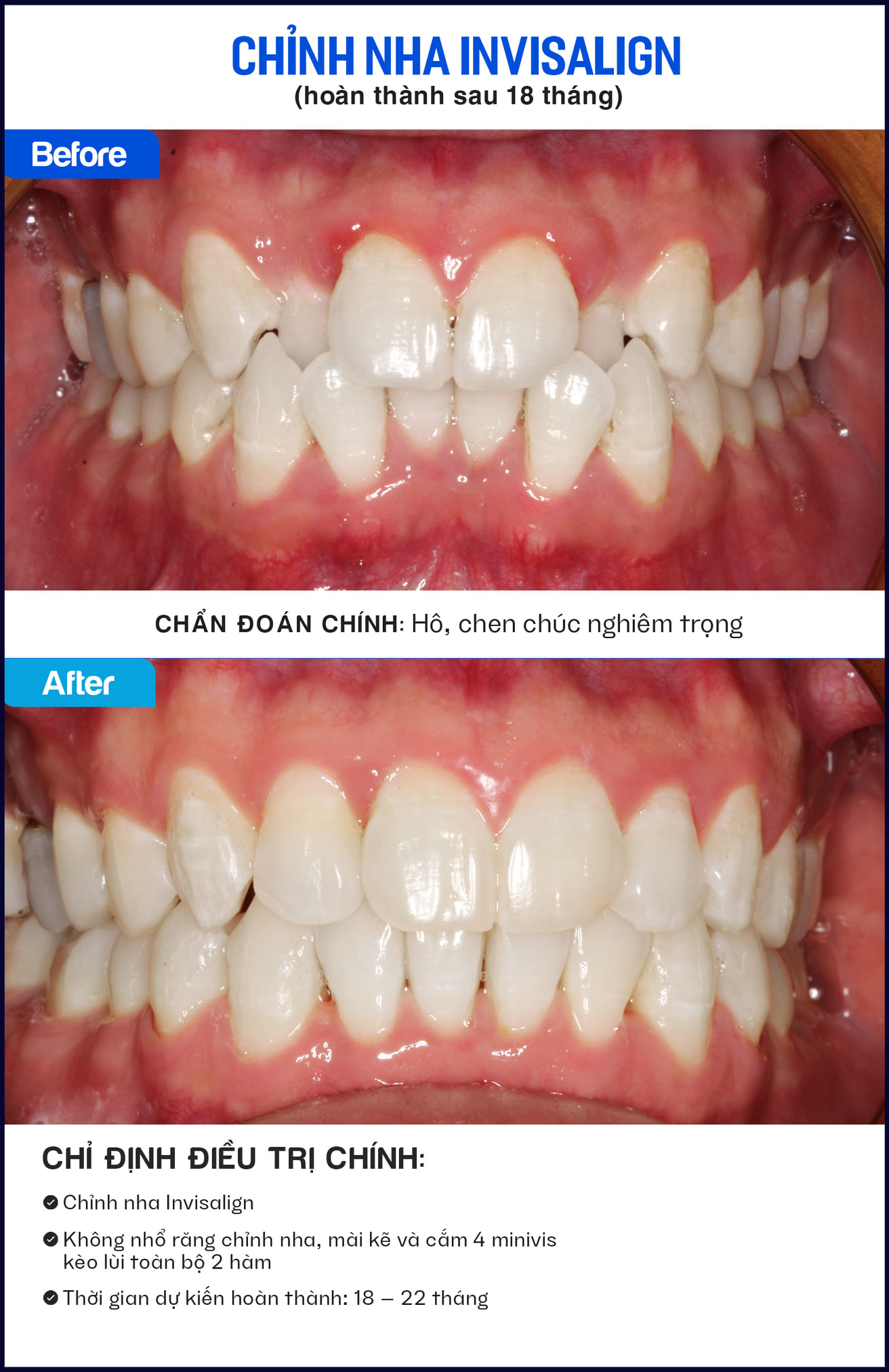 niềng răng invisalign cho răng hô chen chúc