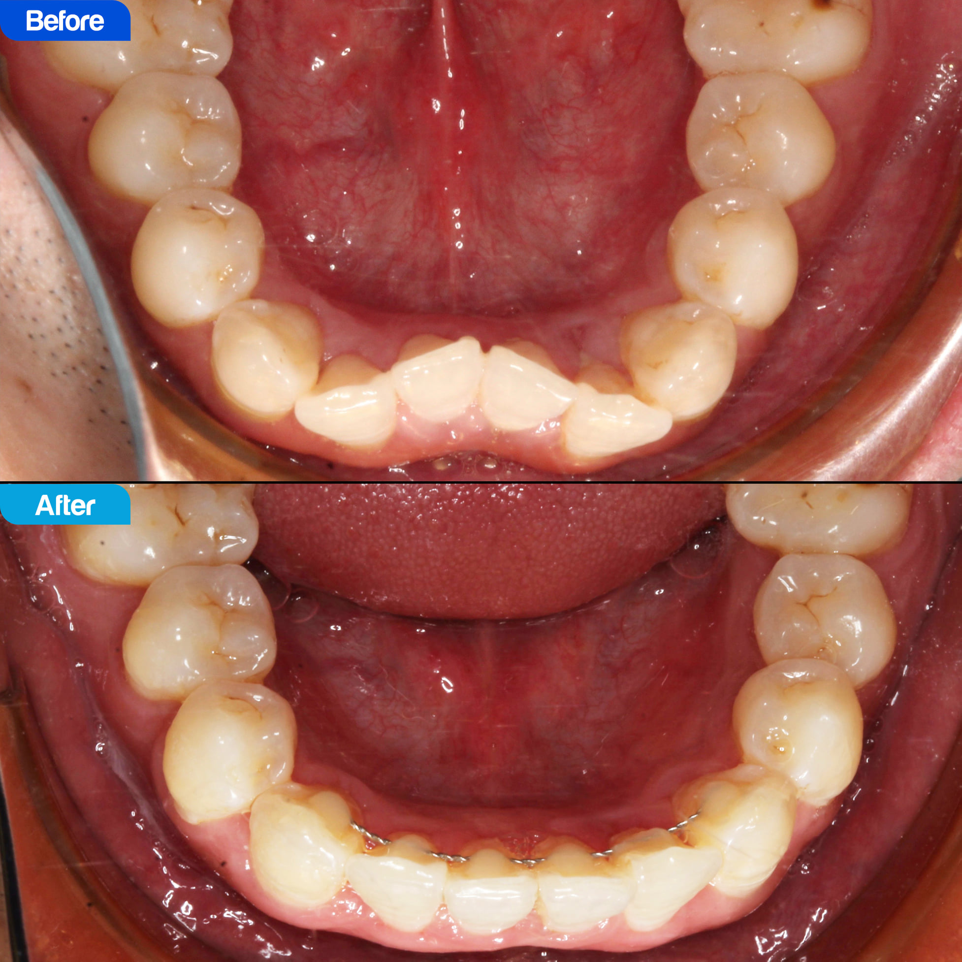 chỉnh nha invisalign cho răng hô chen chúc