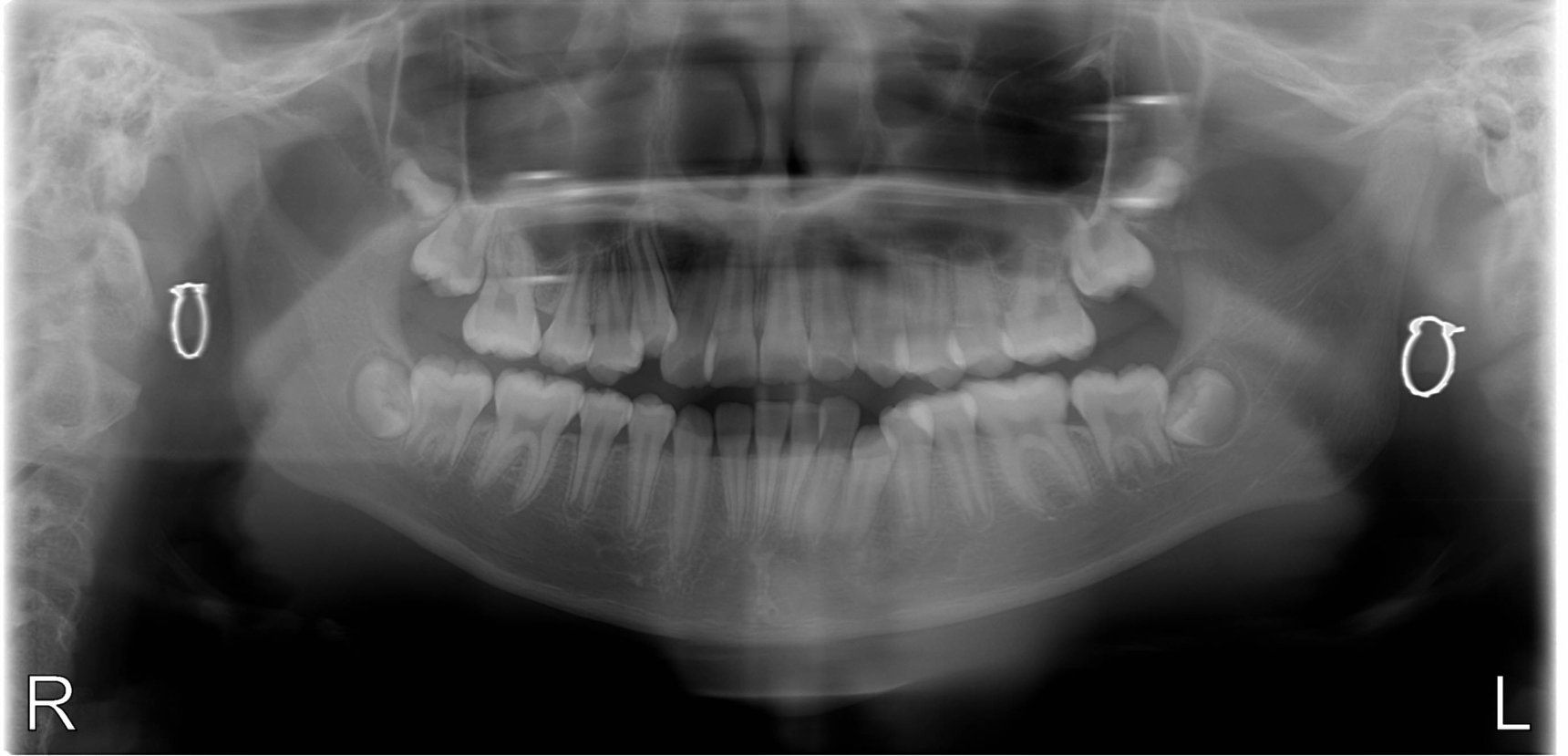 niềng răng mắc cài cho bé 14 tuổi 1