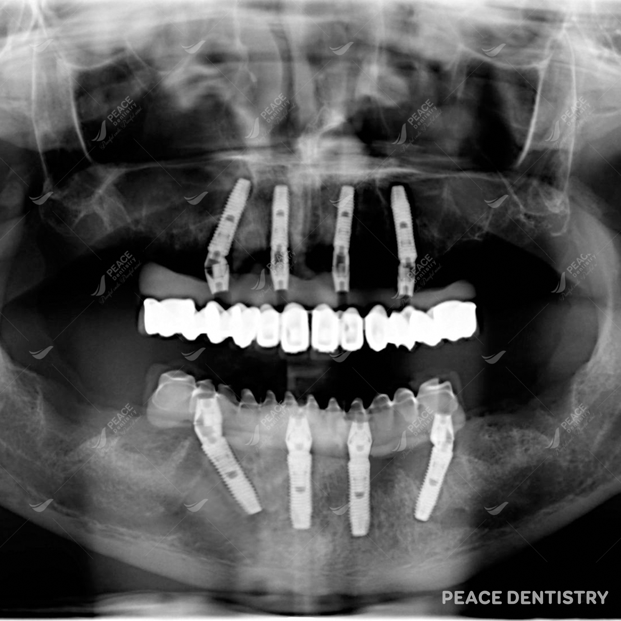 trồng răng implant all on 4 cho răng viêm nha chu