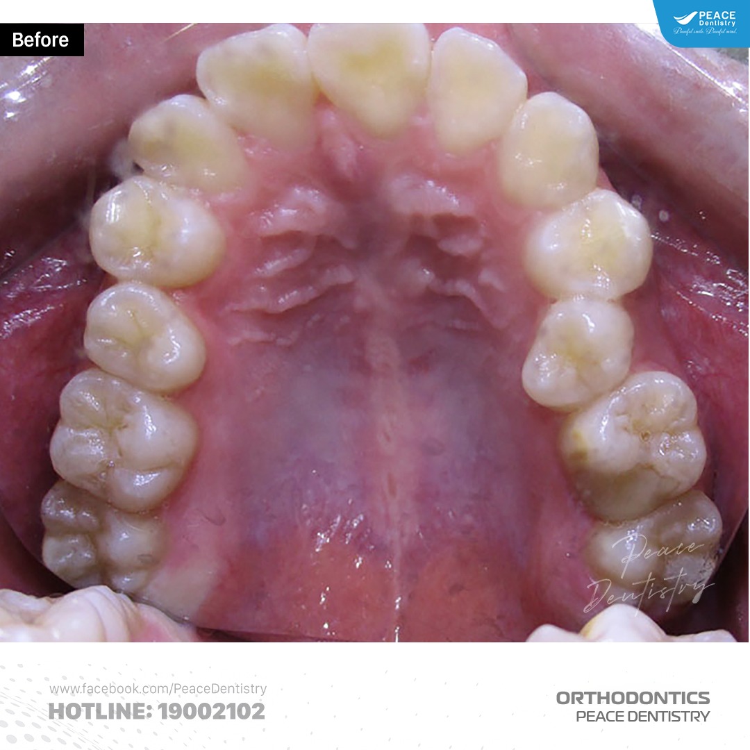 case chỉnh nha răng mọc ngầm, chen chúc, lệch đường giữa 3