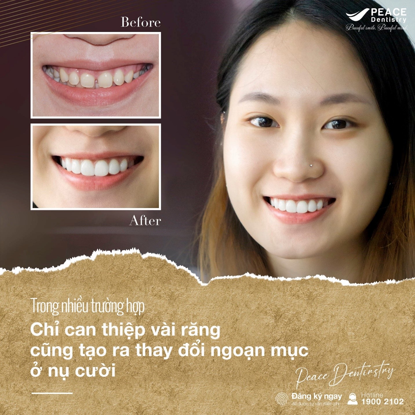 case dán sứ veneer cho răng cửa thưa tại peace dentistry