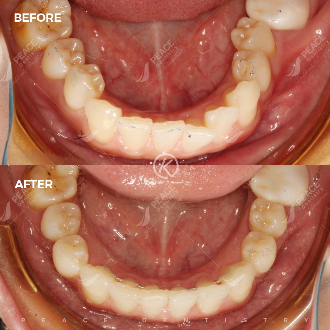 niềng răng invisalign cho răng chen chúc cắn chéo sai khớp cắn 1