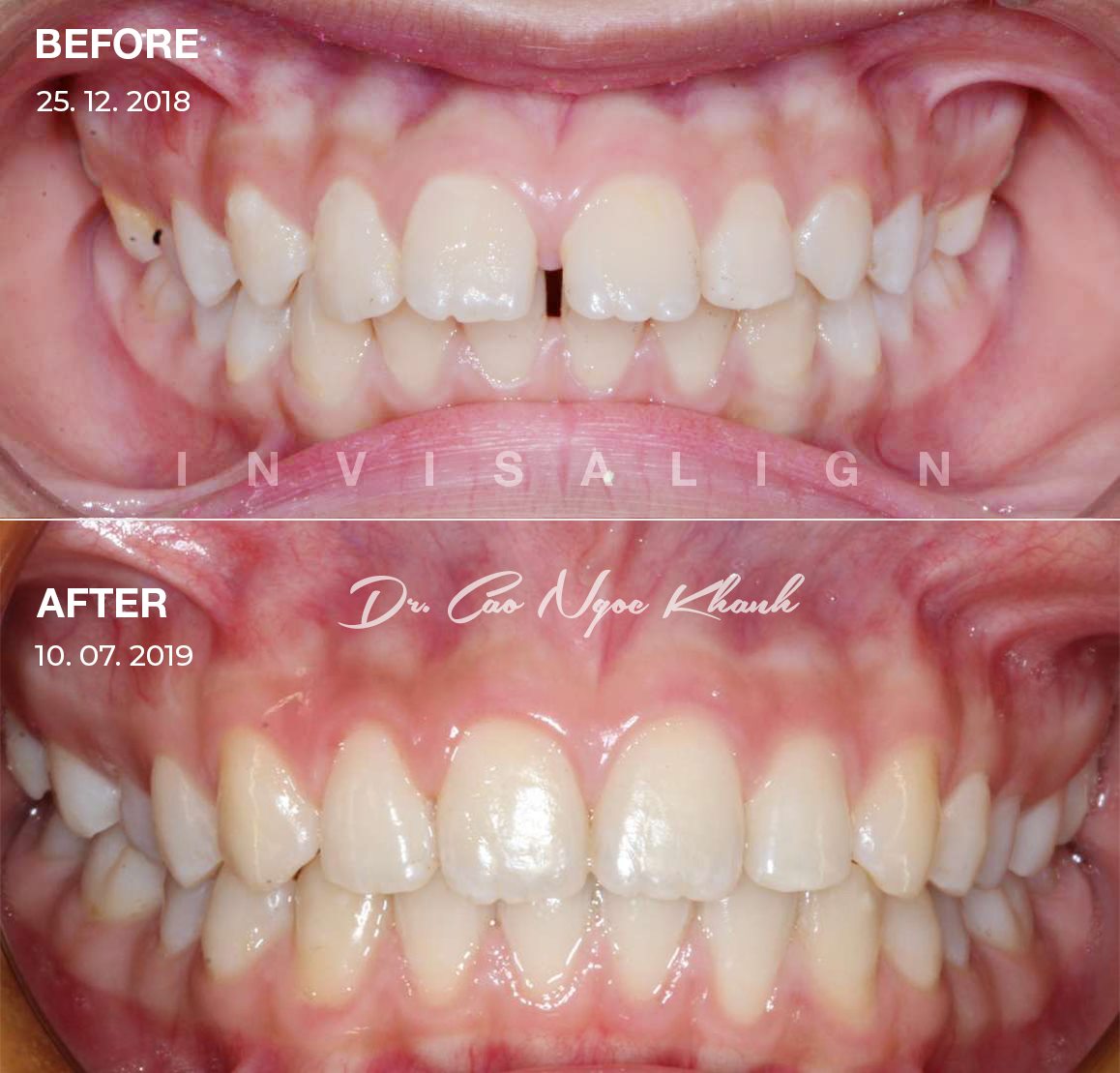 niềng răng invisalign hở kẽ 2 hàm cắn sâu thời gian 8 tháng 1