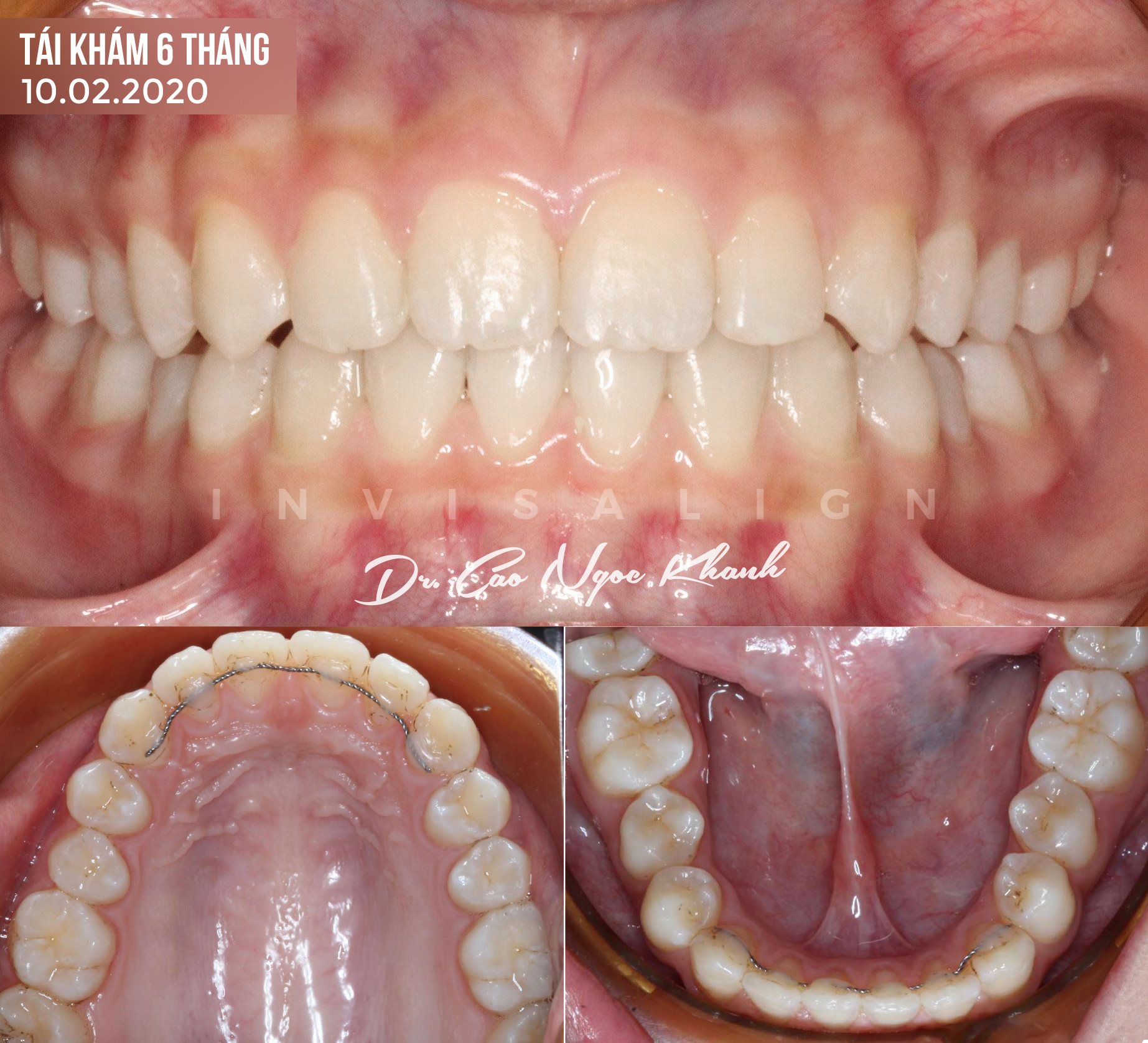 niềng răng invisalign hở kẽ 2 hàm cắn sâu thời gian 8 tháng 4