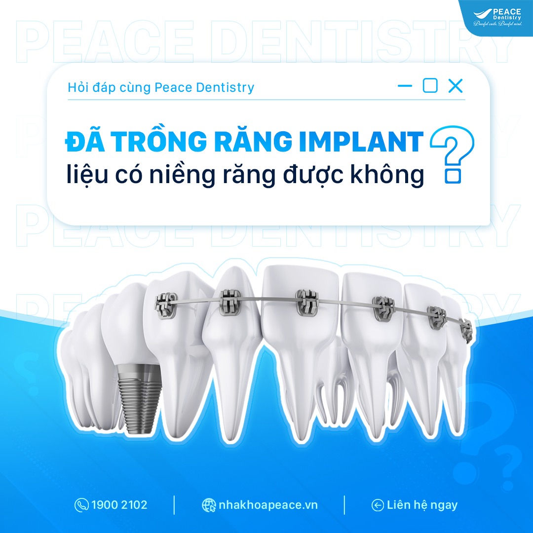 trồng răng implant có niềng được không