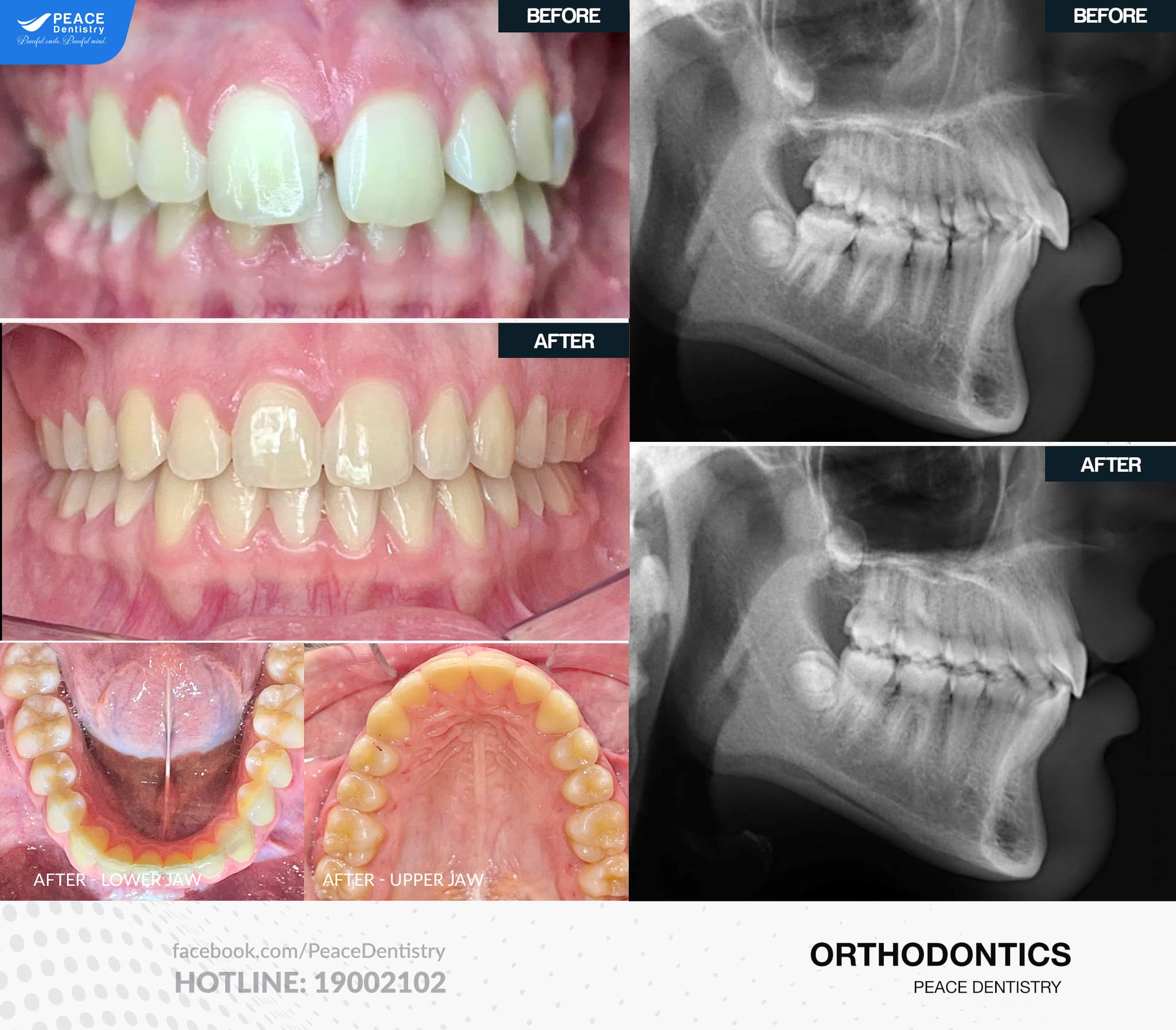 kết quả niềng răng cửa thưa tại peace dentistry