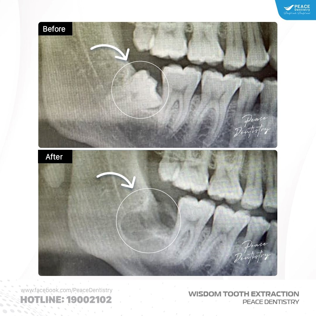 nhổ răng khôn bảo vệ sức khoẻ răng miệng