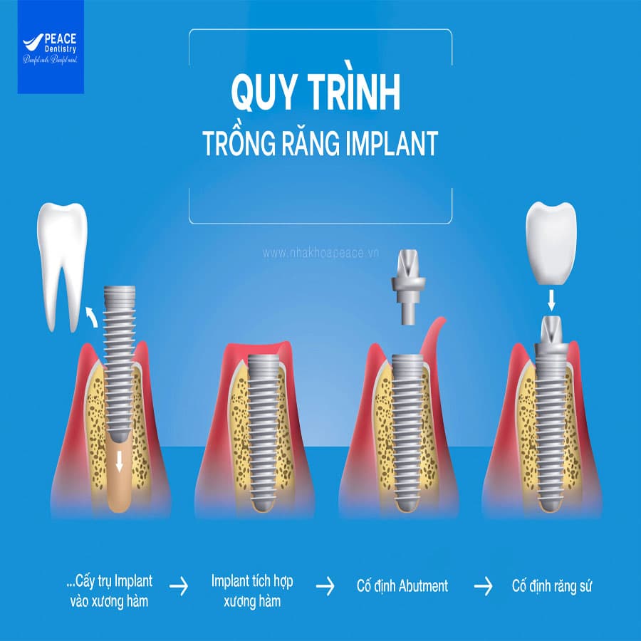 quy trình cấy ghép implant tại peace dentistry