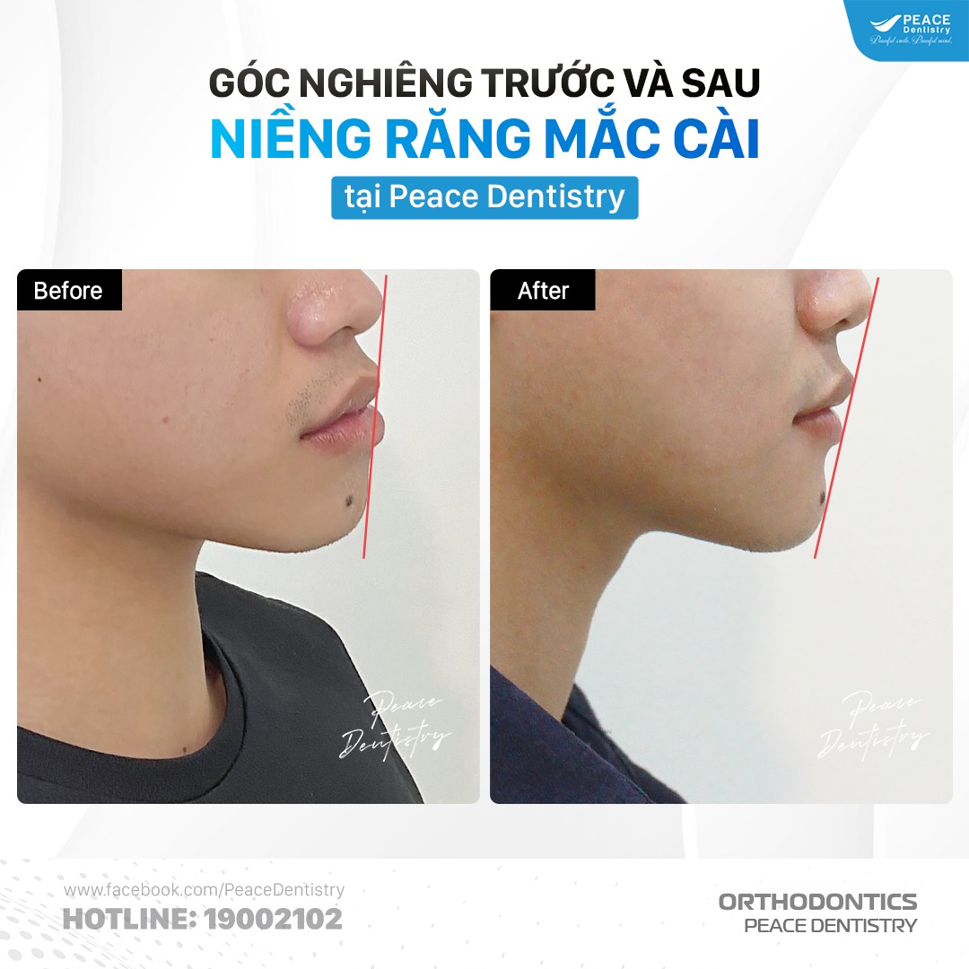 hình ảnh ca lâm sàng trước và sau khi niềng răng của bạn trường giang