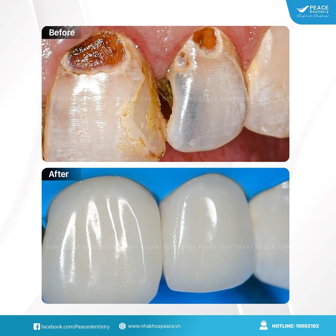 trám răng tăng tính thẩm mỹ