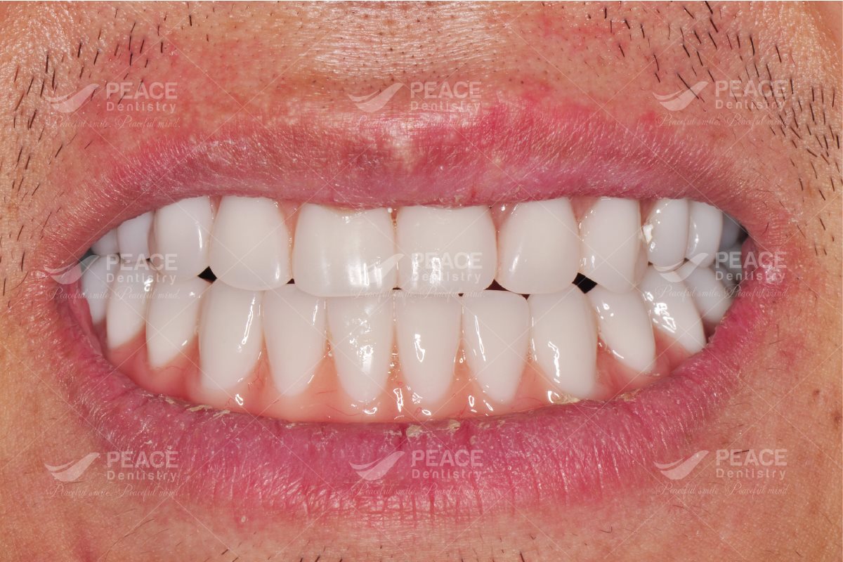 trồng răng implant nguyên hàm all on 4 cho việt kiều mỹ 1