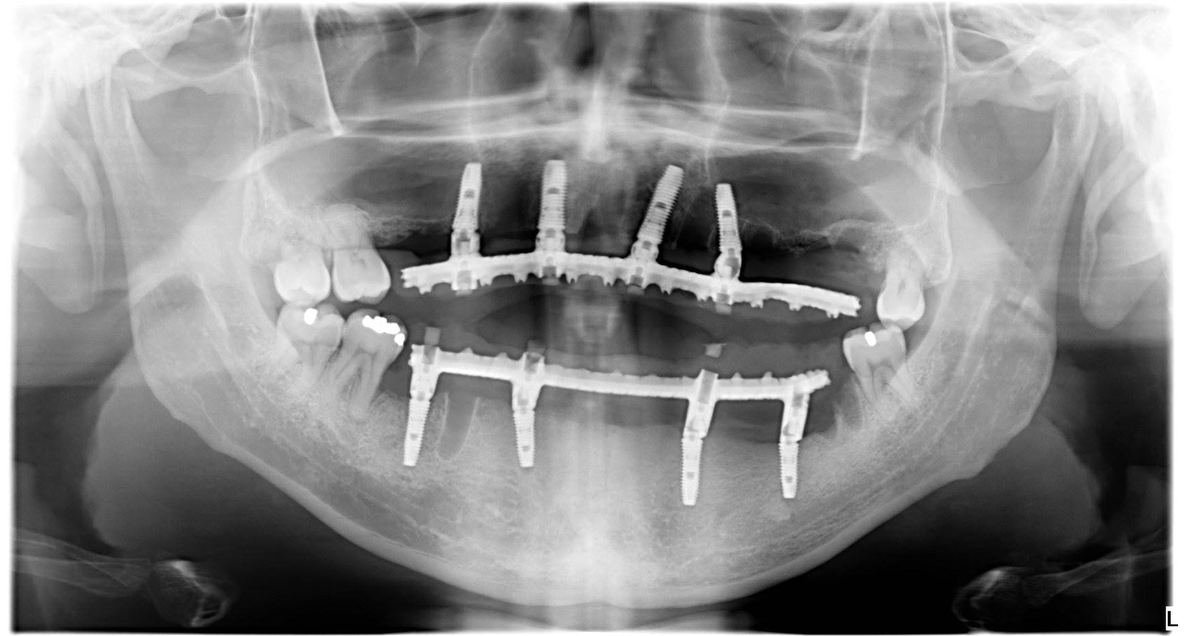 trồng răng implant nguyên hàm all on 4 cho việt kiều mỹ 4