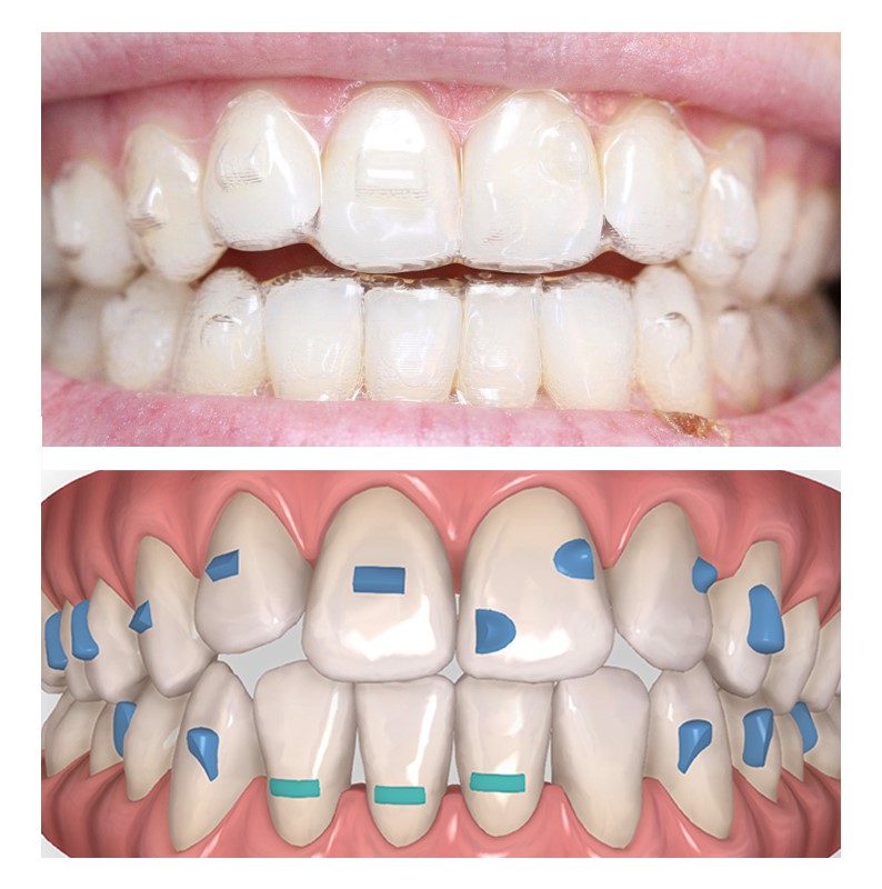 attachment invisalign